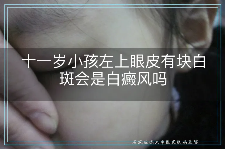 十一岁小孩左上眼皮有块白斑会是白癜风吗