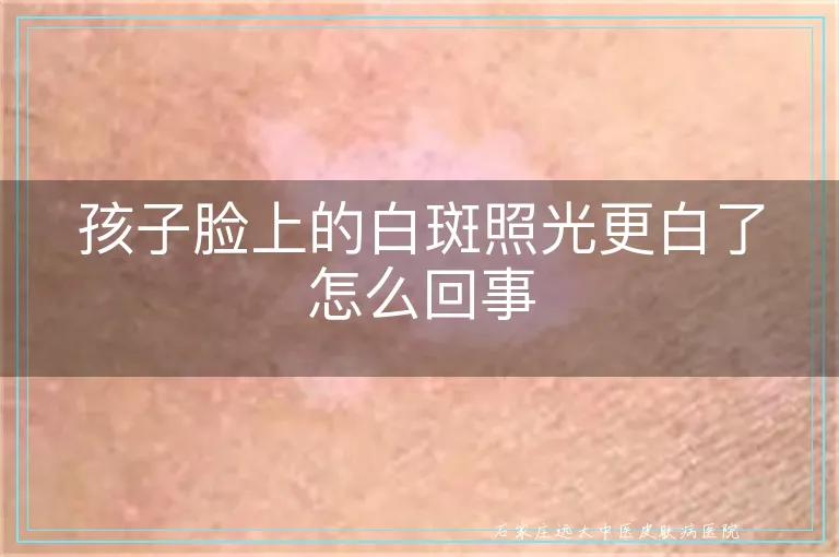 孩子脸上的白斑照光更白了怎么回事