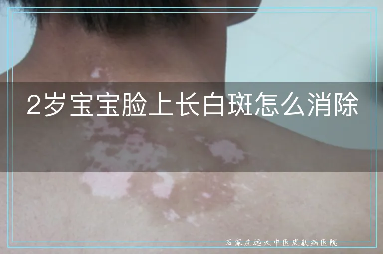 2岁宝宝脸上长白斑怎么消除