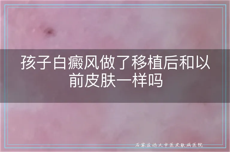 孩子白癜风做了移植后和以前皮肤一样吗