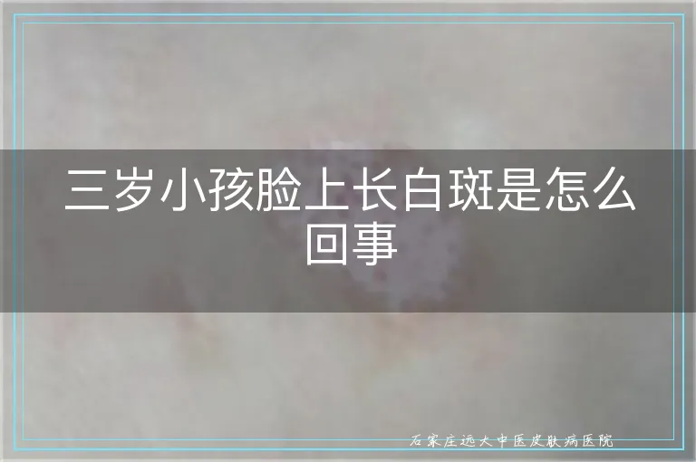 三岁小孩脸上长白斑是怎么回事