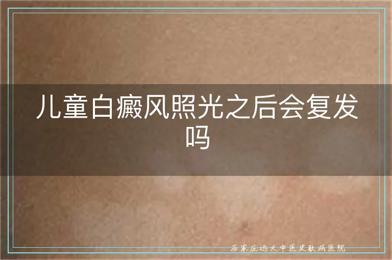 儿童白癜风照光之后会复发吗