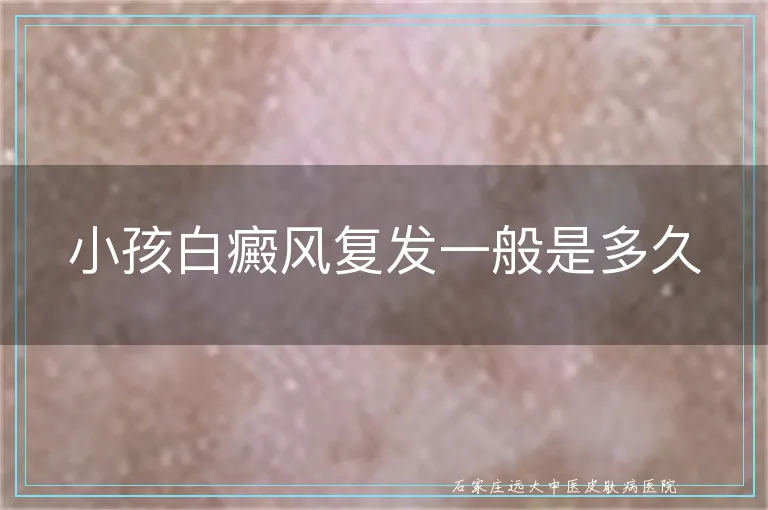 小孩白癜风复发一般是多久