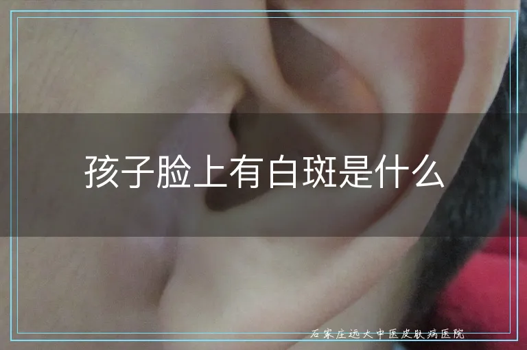 孩子脸上有白斑是什么