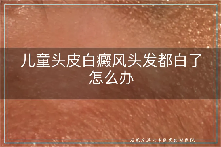 儿童头皮白癜风头发都白了怎么办