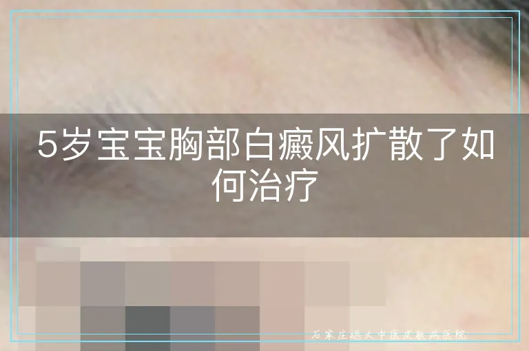 5岁宝宝胸部白癜风扩散了如何治疗