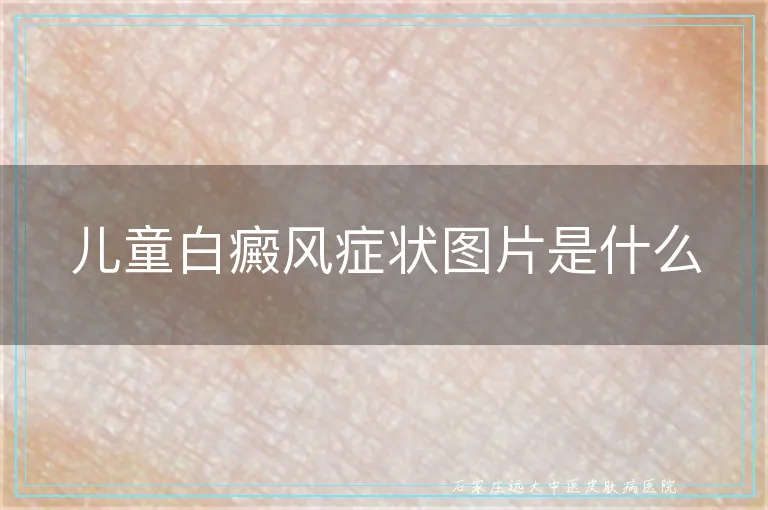 儿童白癜风症状图片是什么