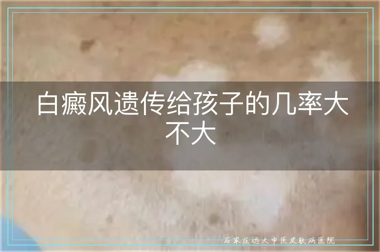 白癜风遗传给孩子的几率大不大