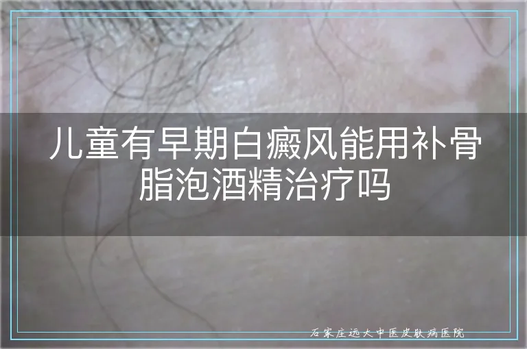 儿童有早期白癜风能用补骨脂泡酒精治疗吗
