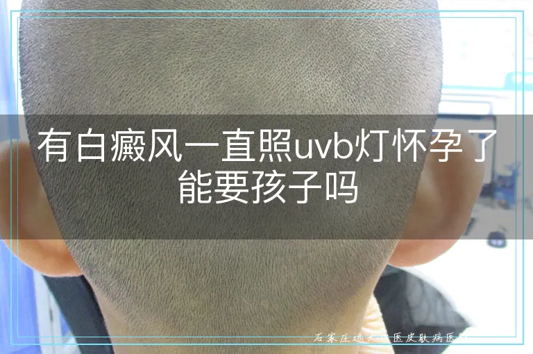 有白癜风一直照uvb灯怀孕了能要孩子吗