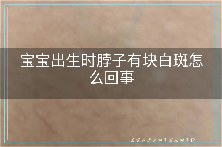 宝宝出生时脖子有块白斑怎么回事