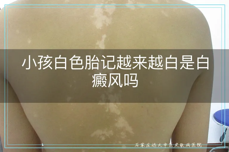 小孩白色胎记越来越白是白癜风吗