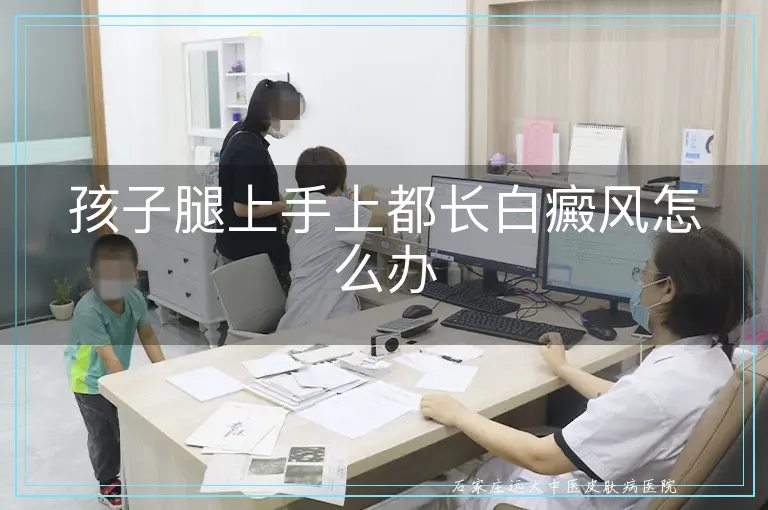孩子腿上手上都长白癜风怎么办