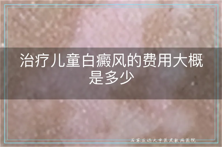 治疗儿童白癜风的费用大概是多少