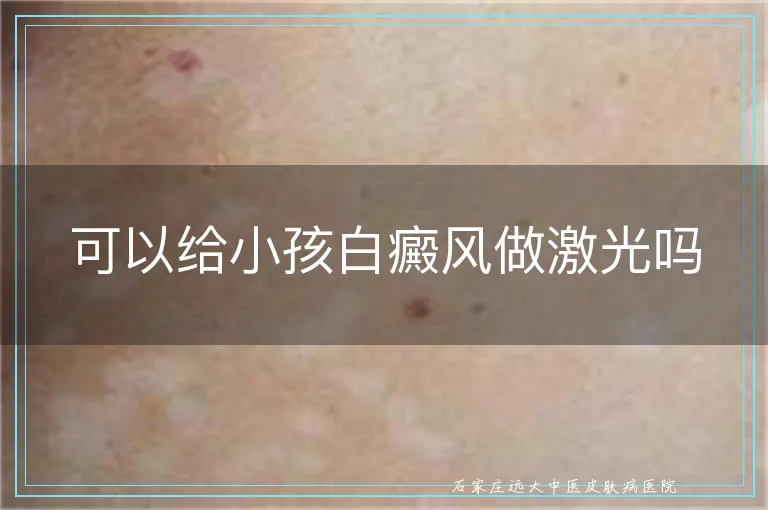可以给小孩白癜风做激光吗