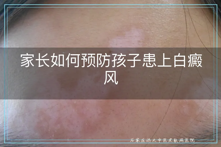 家长如何预防孩子患上白癜风