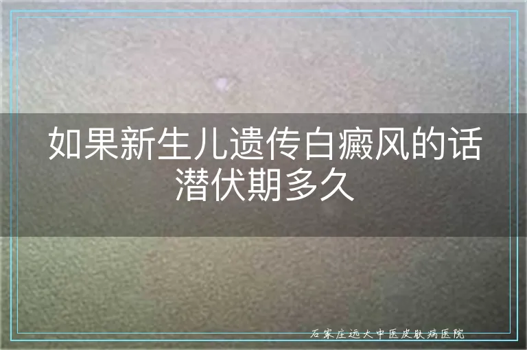 如果新生儿遗传白癜风的话潜伏期多久