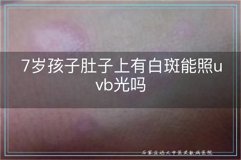 7岁孩子肚子上有白斑能照uvb光吗