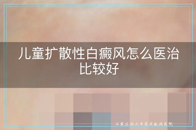 儿童扩散性白癜风怎么医治比较好