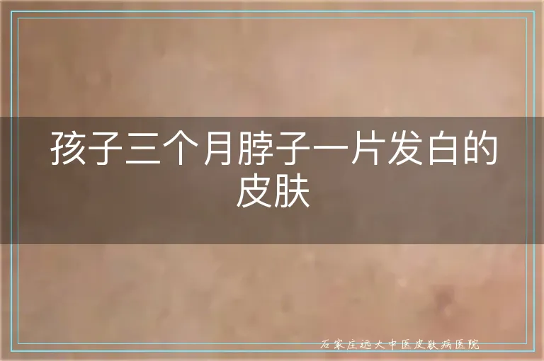 孩子三个月脖子一片发白的皮肤