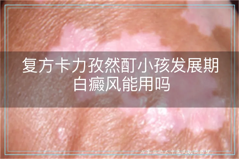 复方卡力孜然酊小孩发展期白癜风能用吗
