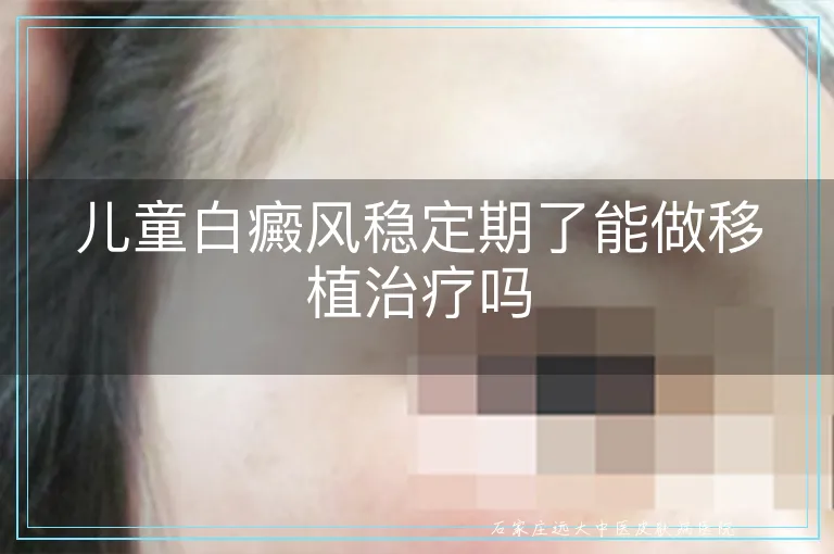 儿童白癜风稳定期了能做移植治疗吗