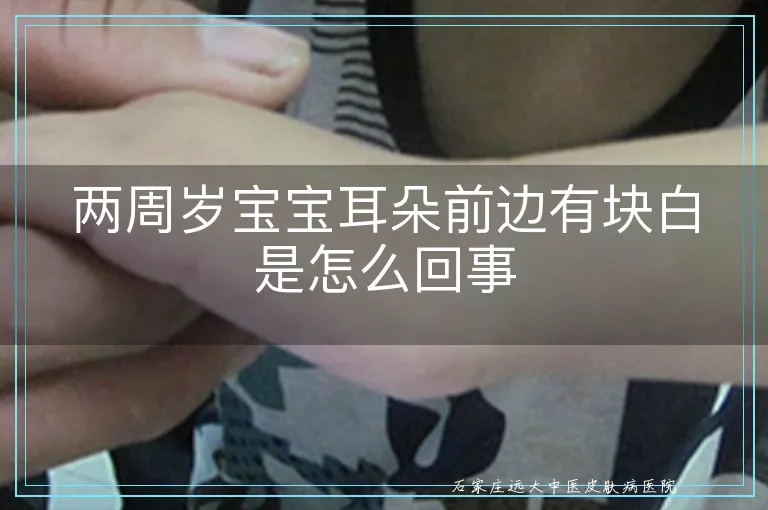 两周岁宝宝耳朵前边有块白是怎么回事