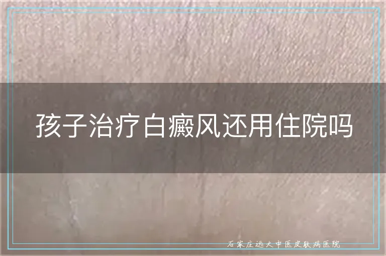 孩子治疗白癜风还用住院吗