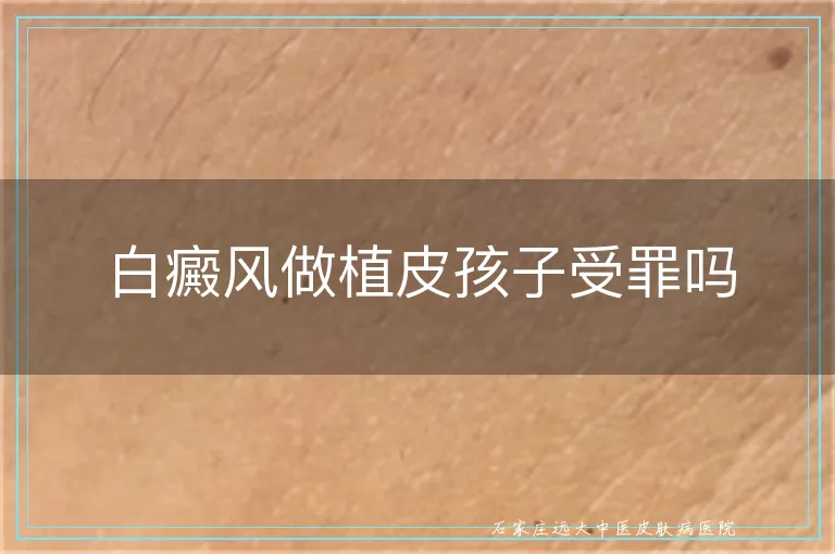 白癜风做植皮孩子受罪吗