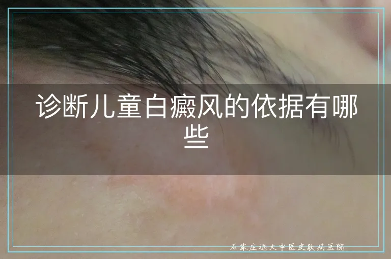 诊断儿童白癜风的依据有哪些