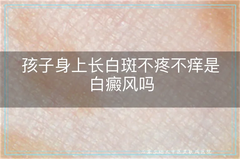 孩子身上长白斑不疼不痒是白癜风吗