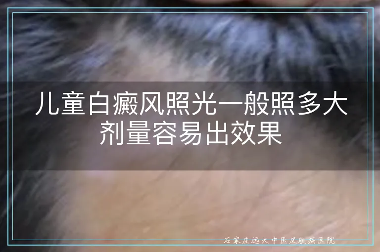 儿童白癜风照光一般照多大剂量容易出效果