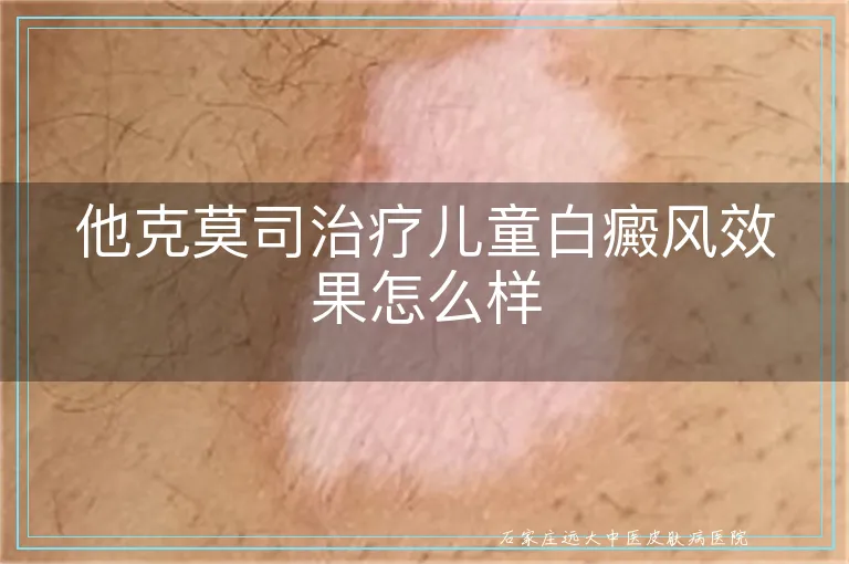 他克莫司治疗儿童白癜风效果怎么样