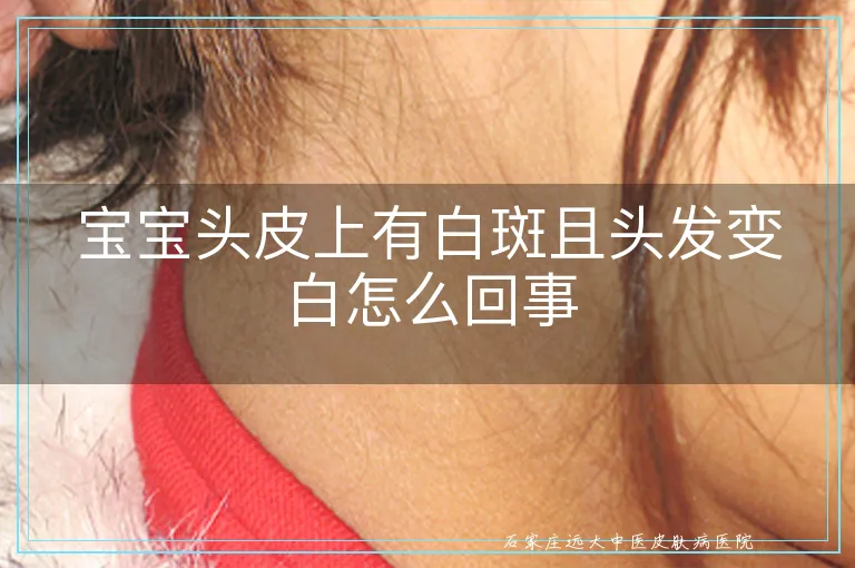 宝宝头皮上有白斑且头发变白怎么回事