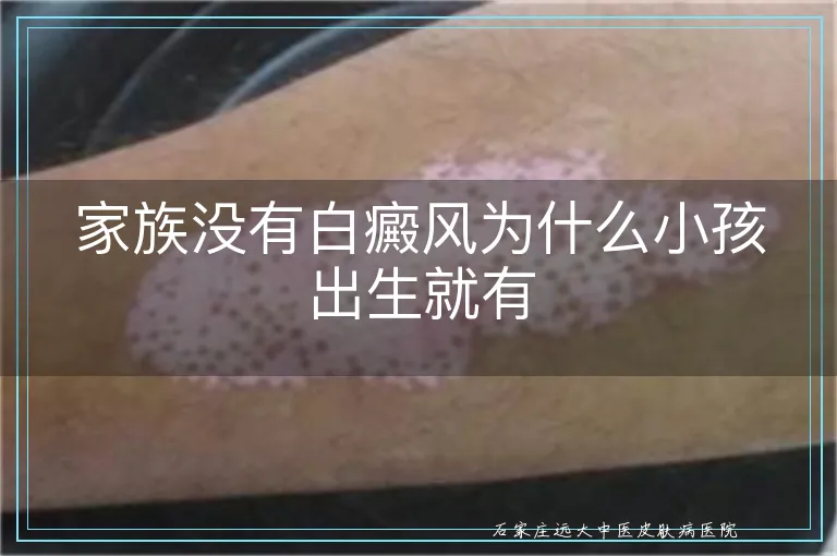 家族没有白癜风为什么小孩出生就有