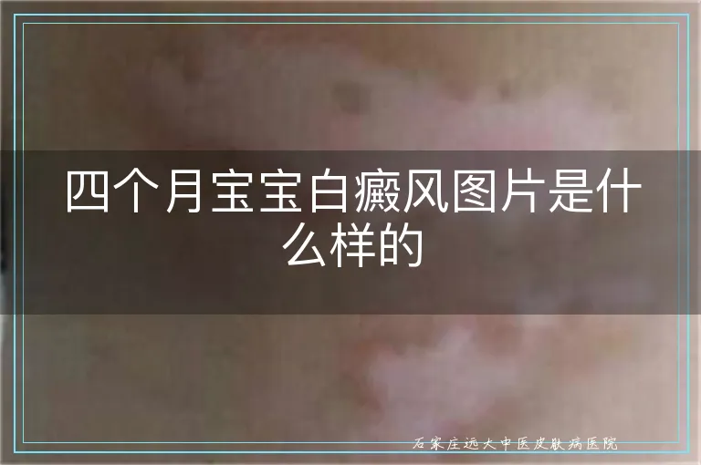 四个月宝宝白癜风图片是什么样的