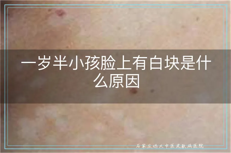 一岁半小孩脸上有白块是什么原因