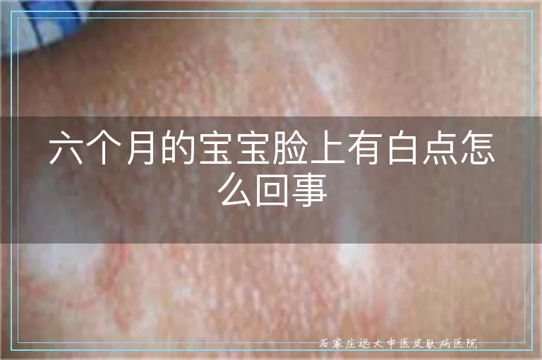 六个月的宝宝脸上有白点怎么回事