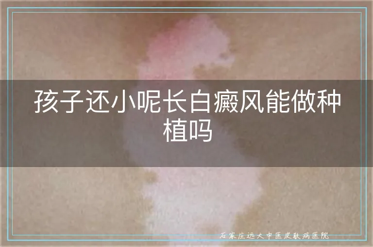 孩子还小呢长白癜风能做种植吗