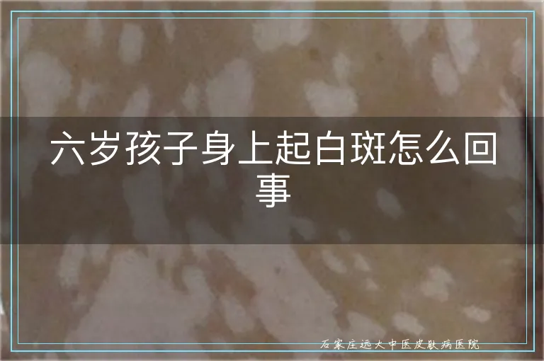 六岁孩子身上起白斑怎么回事