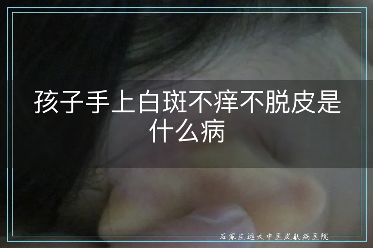 孩子手上白斑不痒不脱皮是什么病