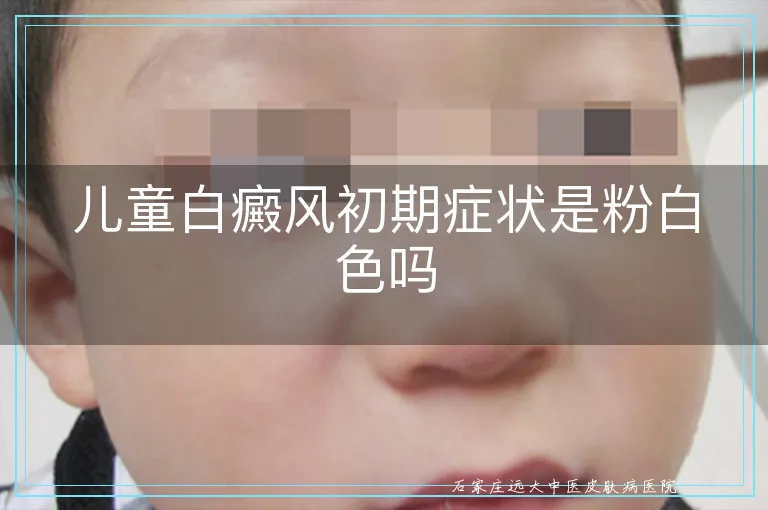 儿童白癜风初期症状是粉白色吗
