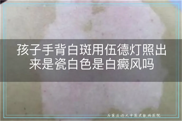 孩子手背白斑用伍德灯照出来是瓷白色是白癜风吗