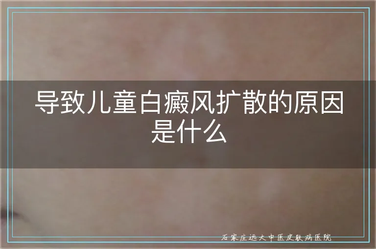 导致儿童白癜风扩散的原因是什么