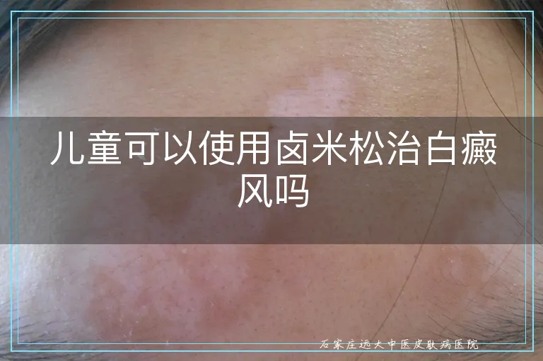 儿童可以使用卤米松治白癜风吗