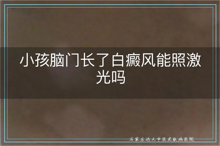小孩脑门长了白癜风能照激光吗