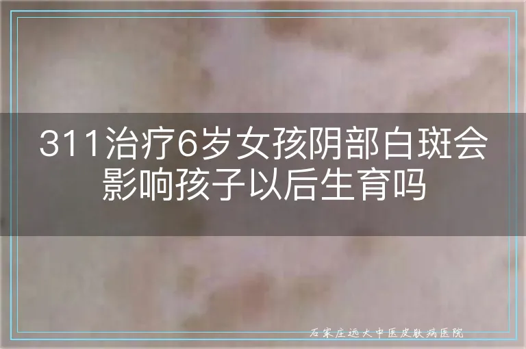 311治疗6岁女孩阴部白斑会影响孩子以后生育吗