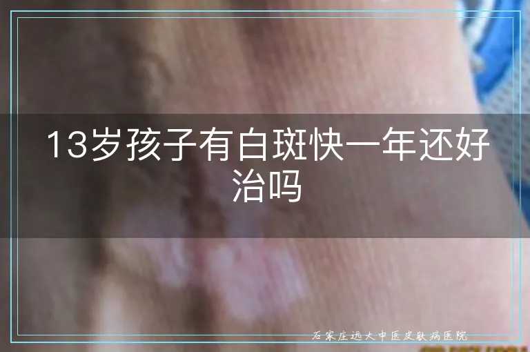 13岁孩子有白斑快一年还好治吗