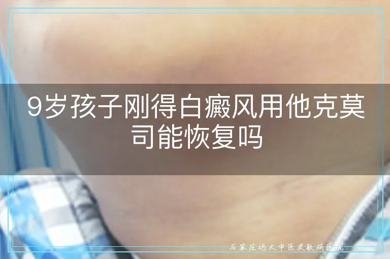 9岁孩子刚得白癜风用他克莫司能恢复吗