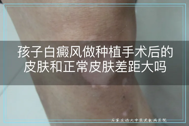 孩子白癜风做种植手术后的皮肤和正常皮肤差距大吗